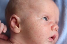 Як відрізнити пітницю від алергії у немовляти (15 фото): потничка і діатез – різниця у новонароджених