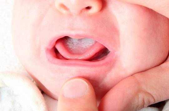 Кандидоз порожнини рота: причини поява, діагностика і лікування