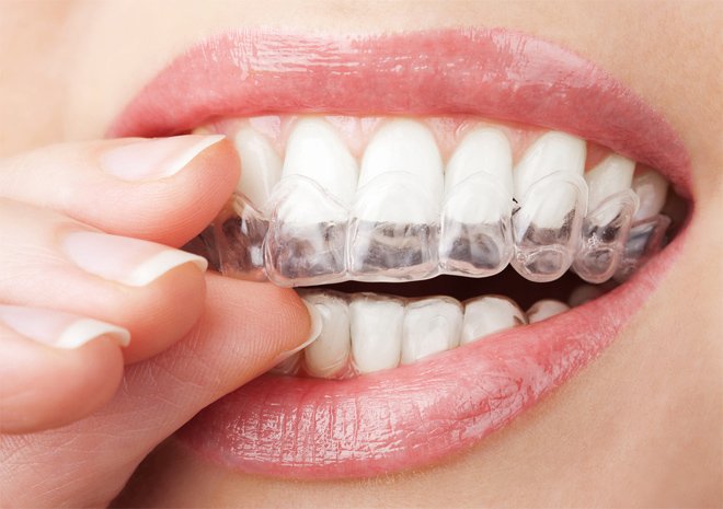 Зубний наліт   як позбутися в домашніх умовах і ефективно очистити зуби