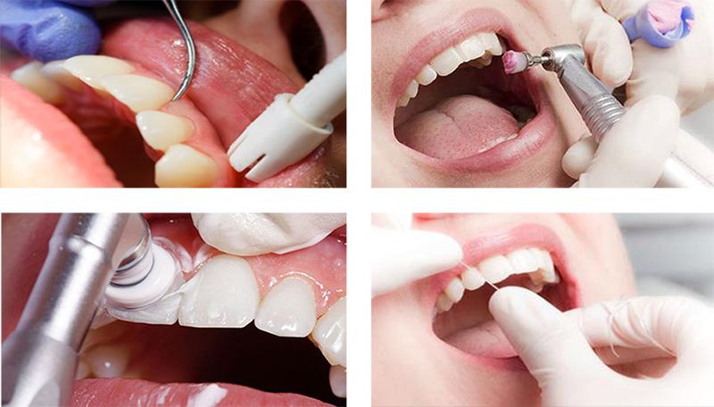 Що таке професійна гігієна порожнини рота: її етапи та особливості