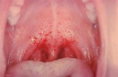 У роті червоні плями: причини виникнення, діагностика і методи лікування