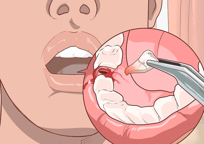 Ускладнення після видалення зубів   причини появи та лікування