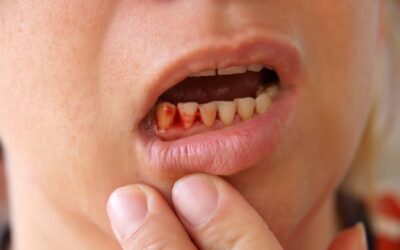 Кровоточать ясна і неприємний запах з рота – причини і лікування