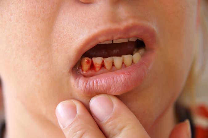 Кровоточать ясна і неприємний запах з рота – причини і лікування