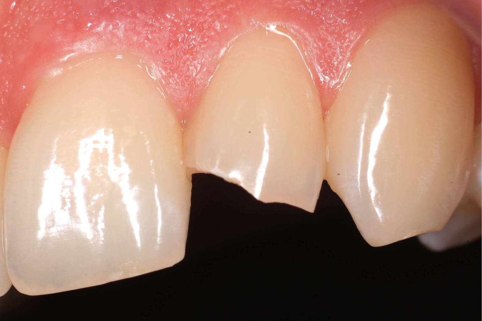 Відколовся шматочок зуба: причини, лікування та можливі ускладнення