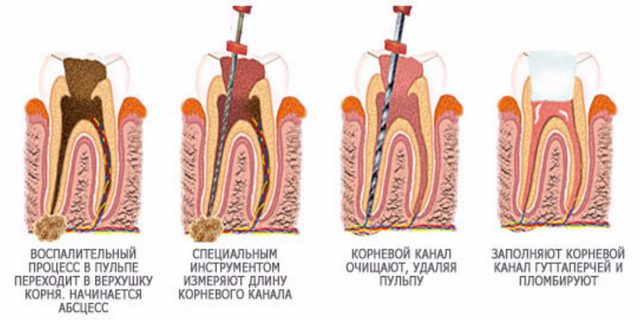 Ендодонтичне лікування зубів: що це таке і як його проводять?