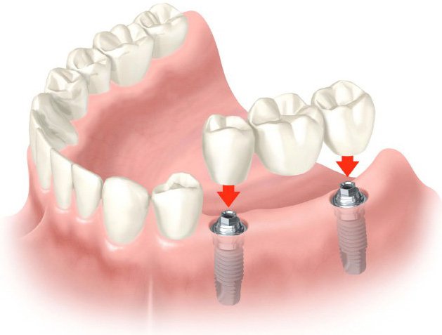 Зубні мости на імплантатах – що краще вибрати?