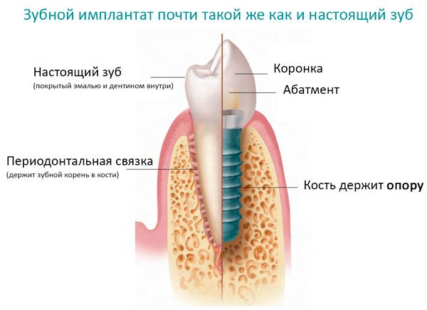 Чи боляче вставляти імплант зуба в десну?