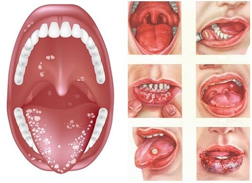 Чим полоскати рот при стоматиті: огляд медичних і народних засобів