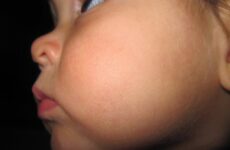 Чому опухла щока у дитини: можливі причини і лікування