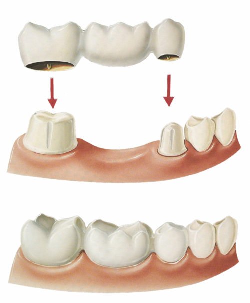 Зубні мости на імплантатах – що краще вибрати?
