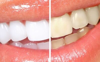 Чим відбілити зуби в домашніх умовах: кращі методи і засоби