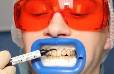 Відбілювання чутливих зубів
