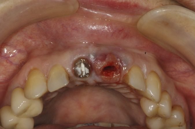 Чому відбувається відторгнення імпланта зуба?