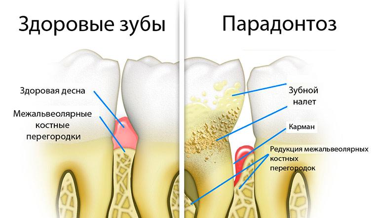 Болять і хитаються зуби: причини, профілактика та методи лікування зубів хиткості