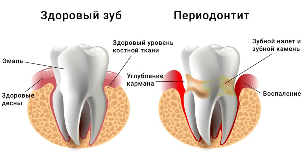 Підвищення температури при зубному болю   причини і методи лікування