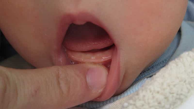 Скільки днів прорізуються перші зуби у дитини: точні терміни