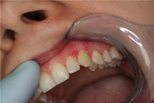 У роті червоні плями: причини виникнення, діагностика і методи лікування