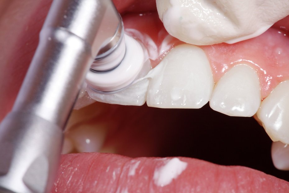 Що таке полірування зубів: особливості проведення процедури
