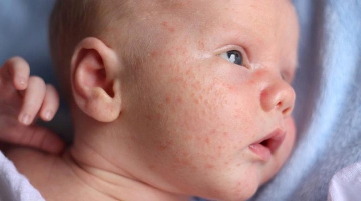 Пітниця на обличчі у немовляти (26 фото): як виглядає і як лікувати, як позбавитися від пелюшкового висипу на голові і шиї, лікування Бепантеном, як прибрати на лобі і щоках