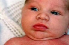 Пітниця у новонароджених (33 фото): як виглядає інфікована потничка, які симптоми у немовляти, 8 місяців і до року, види та як проявляється