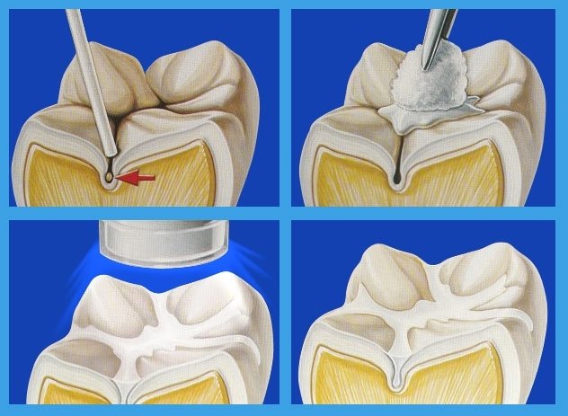 Що таке фиссура зуба: особливості процедури