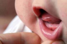 Свічки при прорізуванні зубів у дітей – кращі препарати