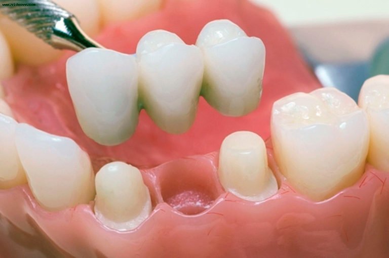Скільки живе зуб без нерва: відгуки стоматологів