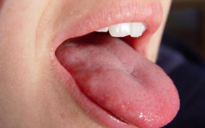 Прищики в роті у дорослих – причини появи та лікування