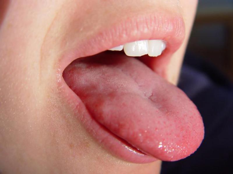 Прищики в роті у дорослих   причини появи та лікування
