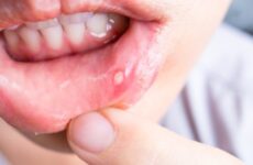 Білі прищики в роті у дитини: як від них позбавитися