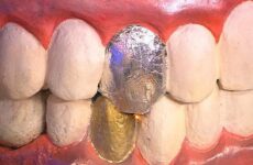 Гальванізм в порожнині рота: причини, симптоми, діагностика і способи лікування