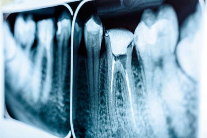 Причини шишки на десні після видалення зуба, а також способи лікування