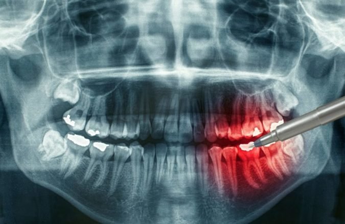 Що робити якщо після видалення зуба залишився осколок?