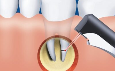 Резекція верхівки кореня зуба: показання до проведення операції