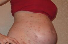 Рожевий лишай Жибера при вагітності: лікування, впливає на плід.
