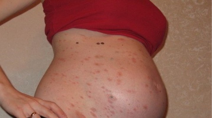 Рожевий лишай Жибера при вагітності: лікування, впливає на плід.