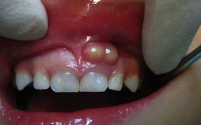 Причини шишки на десні після видалення зуба, а також способи лікування