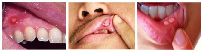 Виразки у роті (афтозний стоматит): причини, лікування, до якого лікаря звернутися