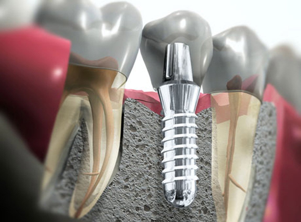 Як довго приживаються зубні імпланти: процес відновлення тканин