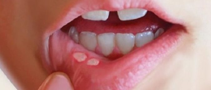 Стоматит на губі: правильна діагностика і лікування