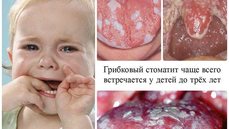 Виразки в роті у дитини: причини появи та методи лікування