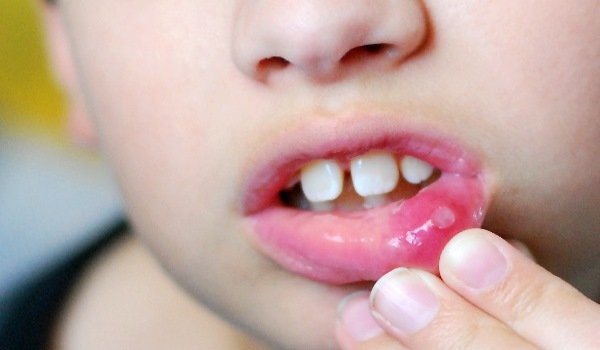 Чому у дитини часто виникає стоматит?
