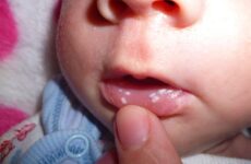 Чим лікують стоматит у немовляти: огляд препаратів