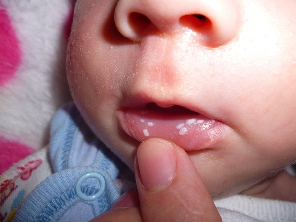 Чим лікують стоматит у немовляти: огляд препаратів