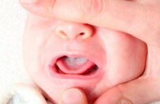 Стоматит у немовляти: причини, симптоми і лікування