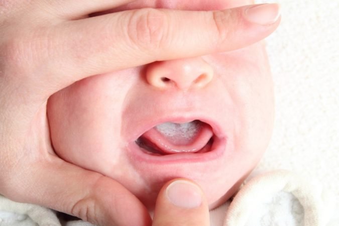 Профілактика стоматиту у дітей, дорослих і новонароджених