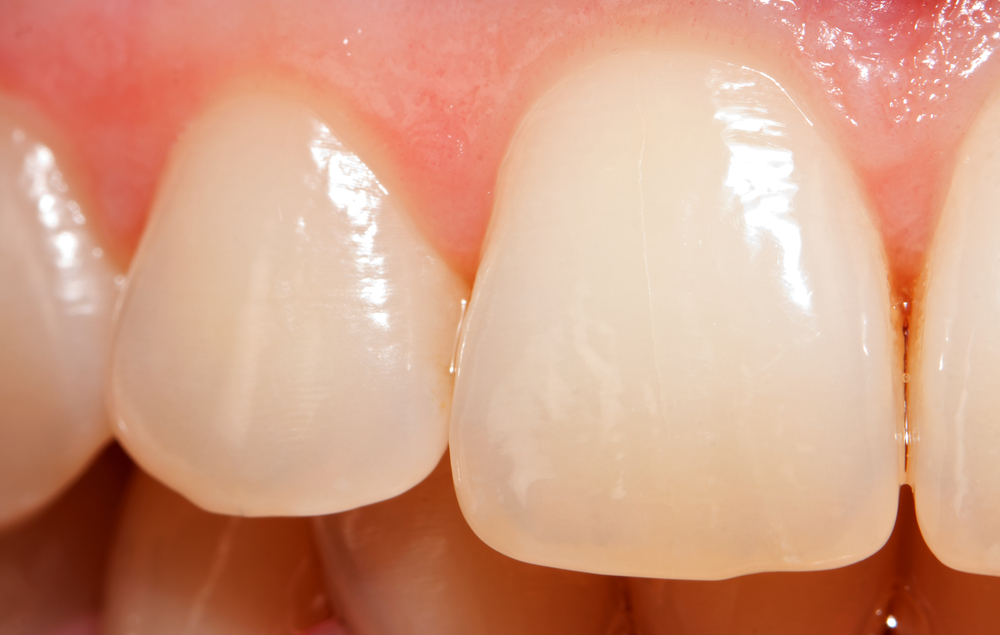Чому зуби стають прозорими: причини і методи лікування