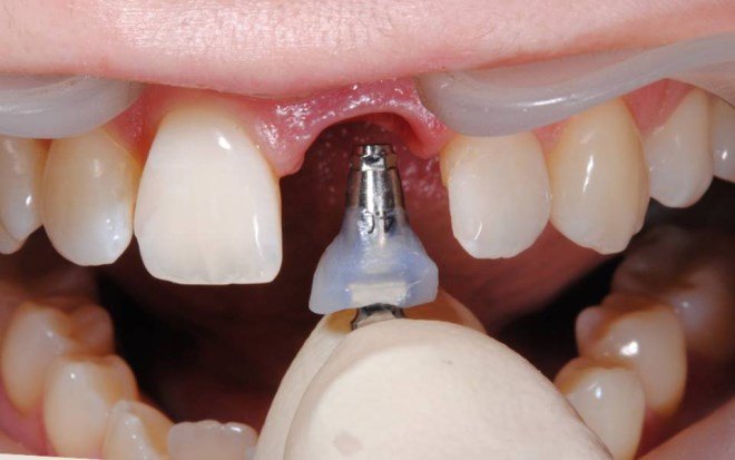 Імплантація передніх зубів: особливості, фото, відгуки пацієнтів