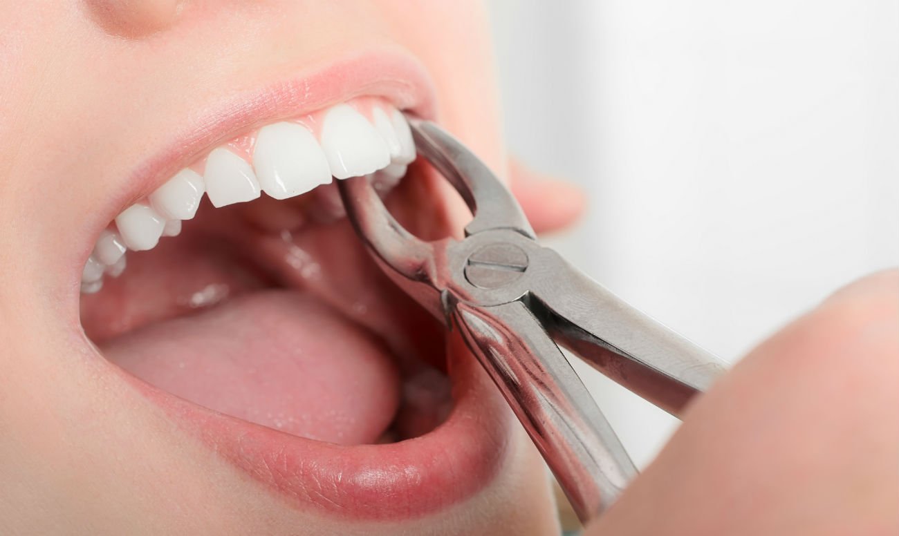 Чи можна видаляти зуби під час місячних: рекомендації експертів